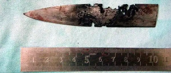 Китаец прожил четыре года с ножом в голове (3 фото)